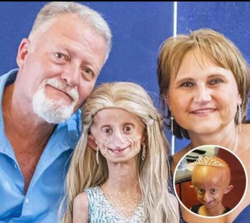 Beandri Booysen: Girl in South Africa with progeria dies